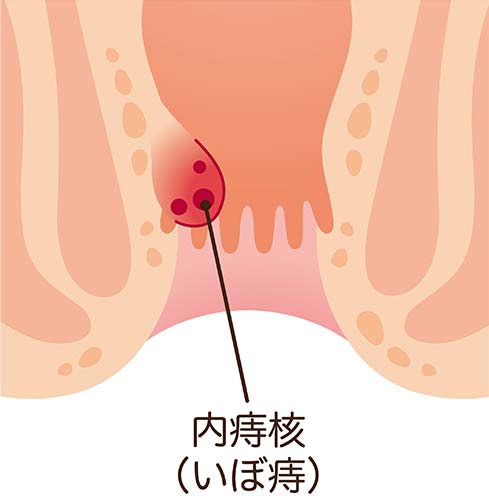 痔核(いぼ痔)イメージ
