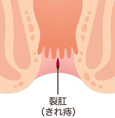 裂肛(切れ痔)イメージ
