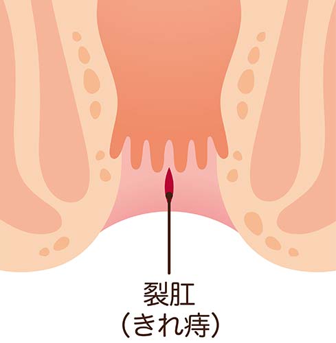 裂肛（切れ痔）イメージ