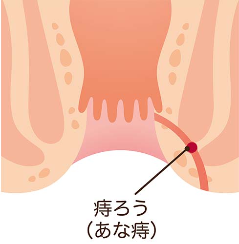 痔瘻（肛門周囲膿瘍）イメージ